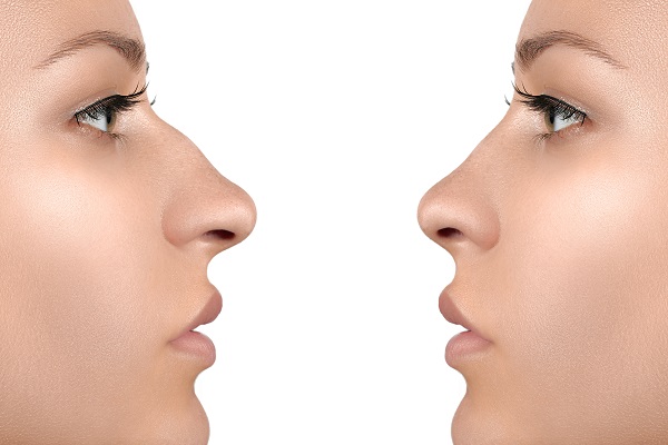 Rinoplastia en Tecate, Baja California